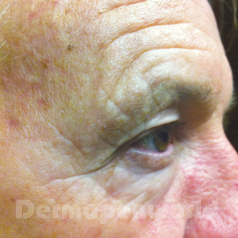 Før Dermapen