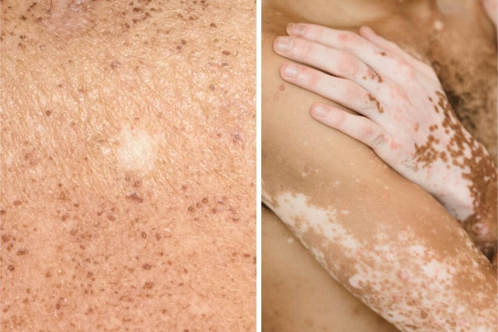 Nærbilde av hud med både en hupopigmentation flekk og vitiligo