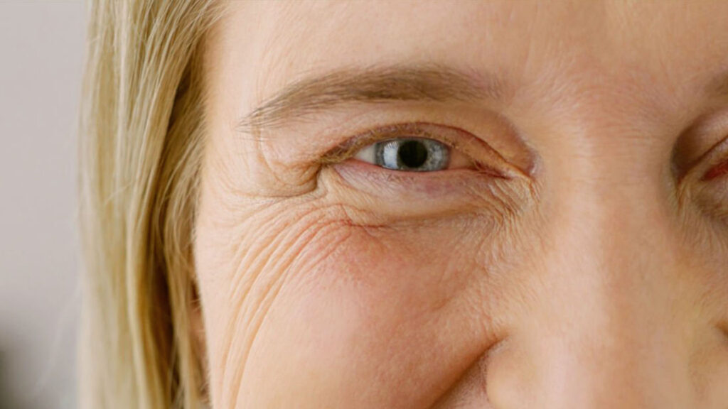 kvinne med linjer i øyenkroken, kalt kråkeføtter, botox behandling