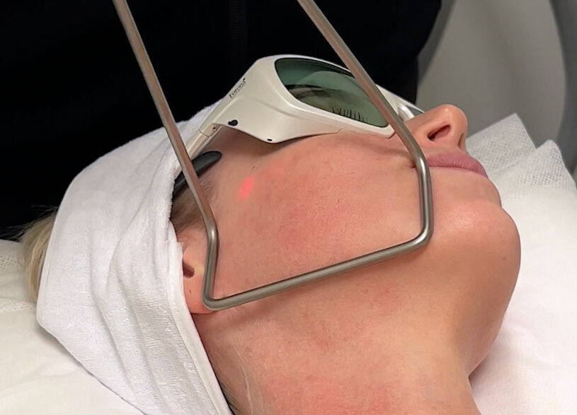 Bildet viser en kvinne som mottar en Fotona tightening laser behandling