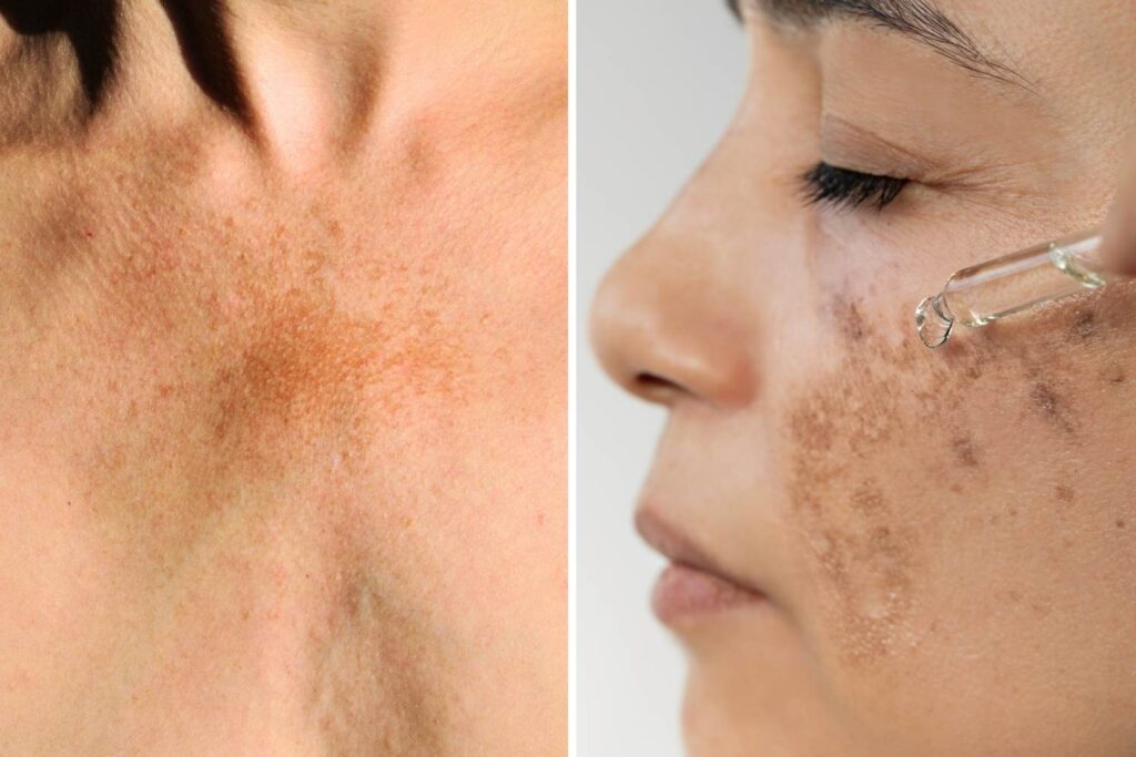 Nærbilder av hud med melasma