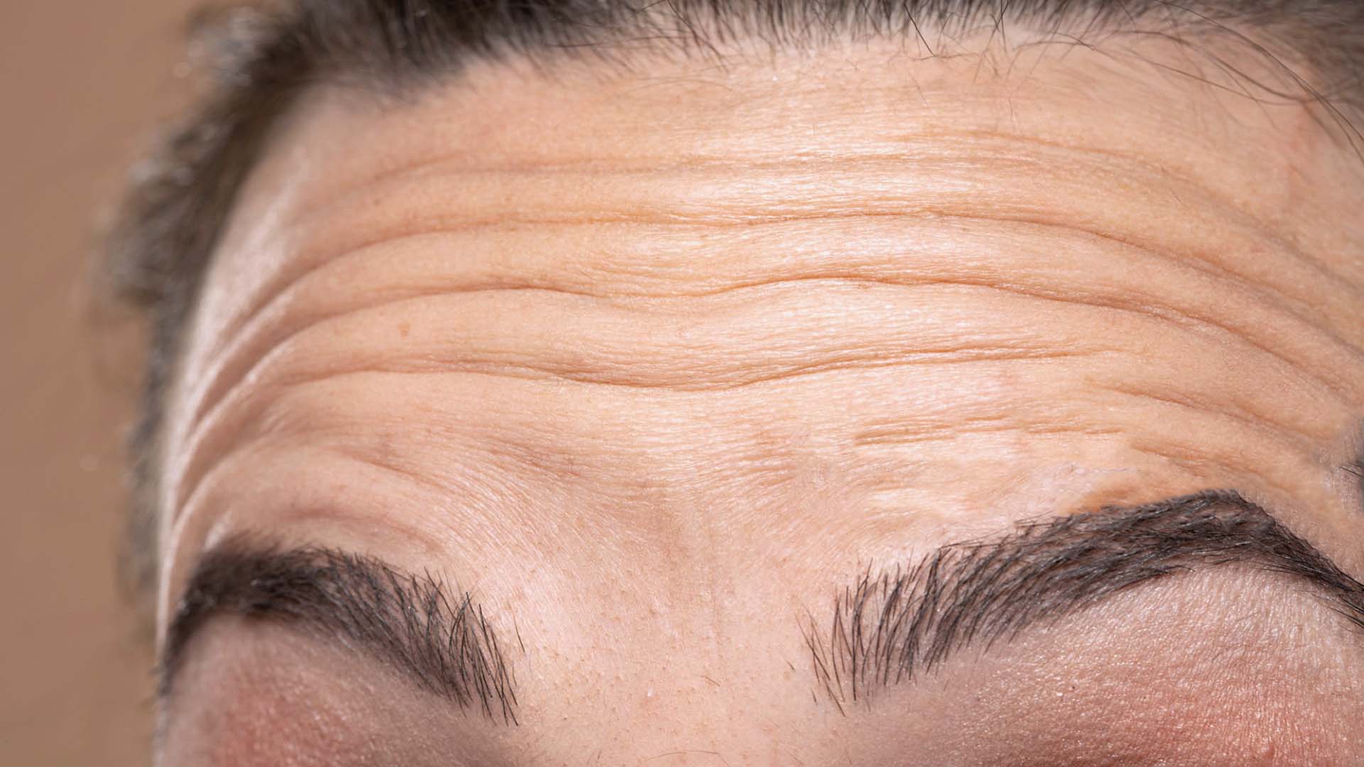 Nærbilde av rynker i pannen som skal behandles med botox