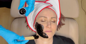 Medisinsk peeling