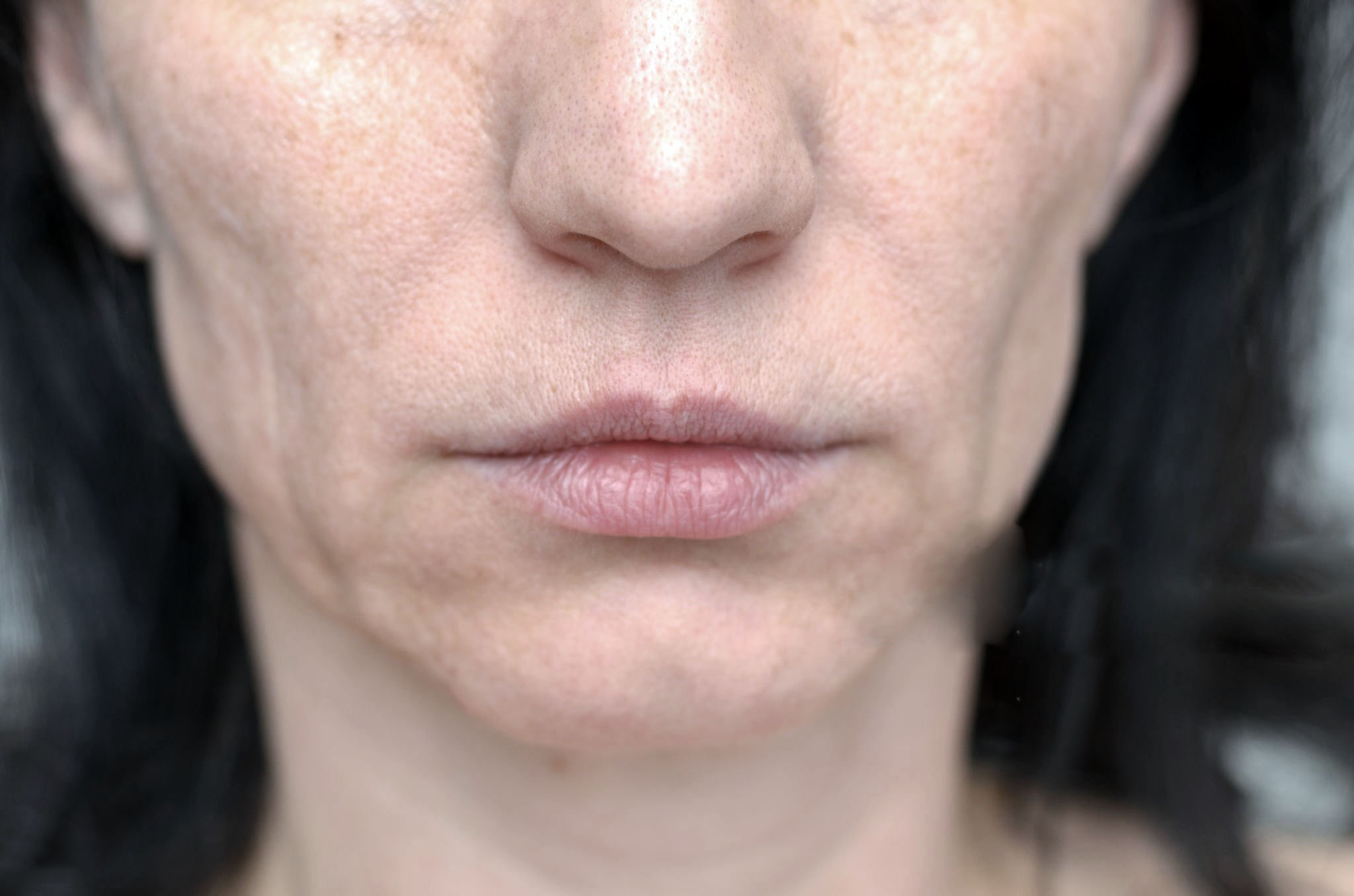Nærbilde av nedre del av ansiktet til en kvinne med aldersrelatert slapp hud rundt kjeven