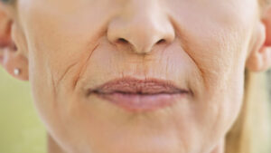 Kvinne med markerte linjer fra nese ned mot munn - nasolabiale linjer behandles med fillers