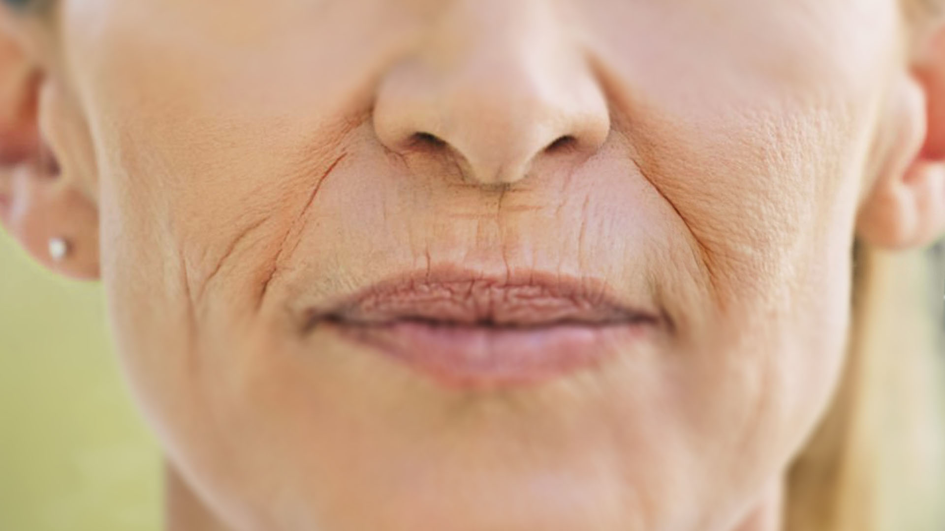 Kvinne med markerte linjer fra nese ned mot munn - nasolabiale linjer behandles med fillers
