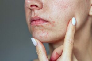 Bildet viser en kvinne med perioral dermatitt rundt munnen