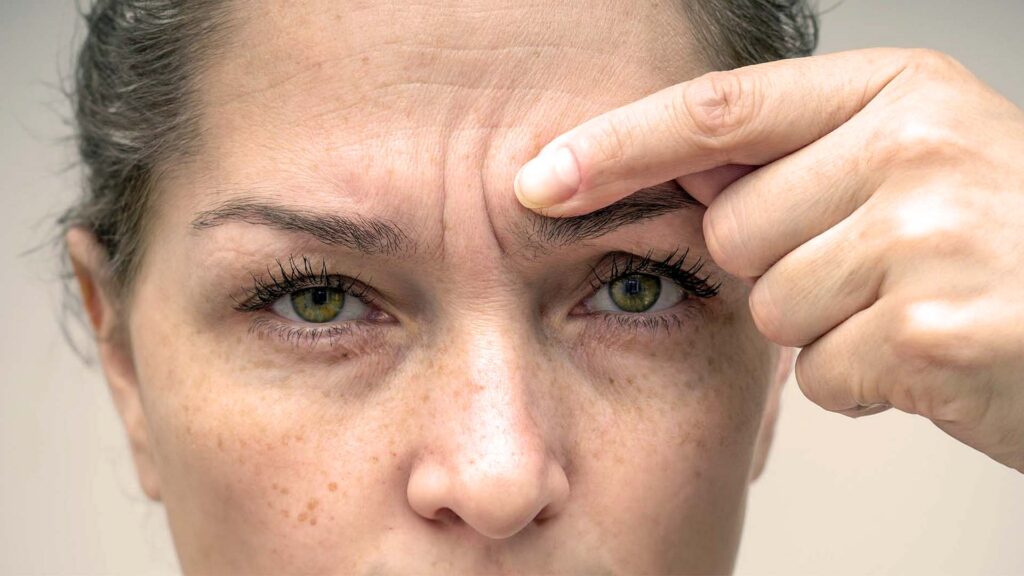 Nærbilde av kvinnes panne og øyne - viser en sinnarynke som skal behandles med botox