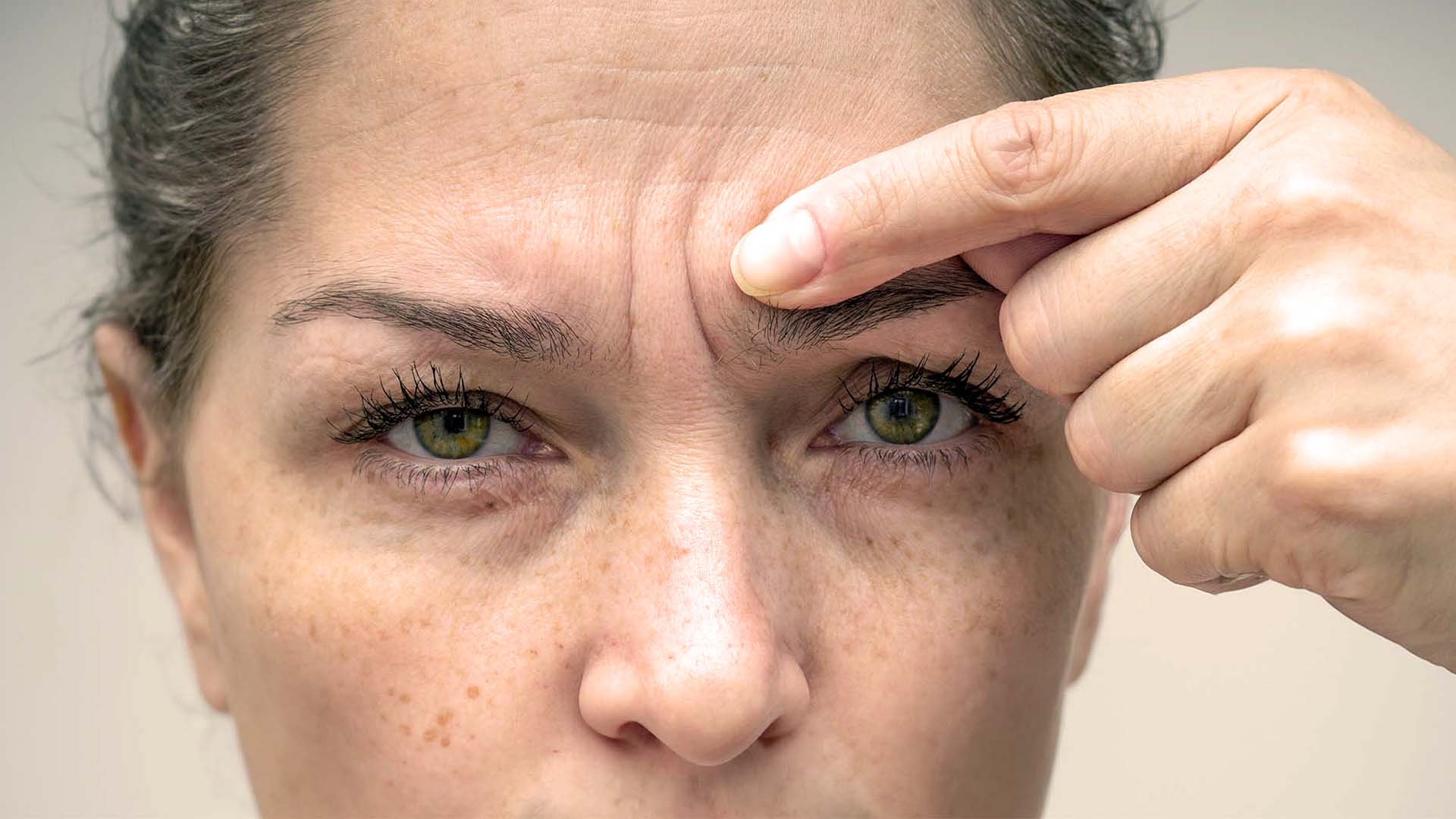 Nærbilde av kvinnes panne og øyne - viser en sinnarynke som skal behandles med botox