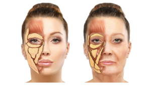 Volumtap i ansiktet ved aldring